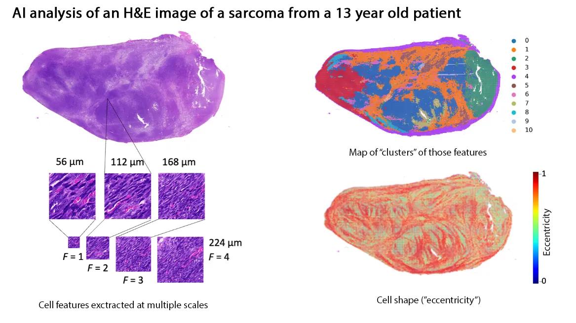Deep learning can interpret patterns in the H&E slides that may be hard to see with the naked eye. The AI program can gather information from the H&E slides at multiple scales (left) and then create an overlay to highlight where similar structures culture (top right). It also provides overlays information about cell shape by measuring “eccentricity” (bottom right). These kinds of overlays help direct a pathologist’s attention to specific areas of the scan for further review.