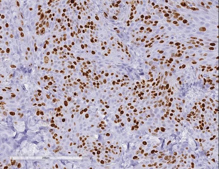 Figure C) Tumor cells of patient origin within the xenograft-stained positive using an anti-human antibody for Ki67.