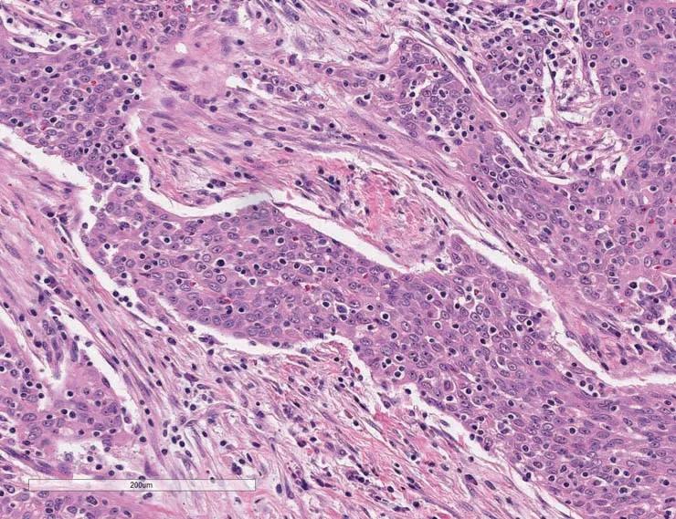 Figure A) Histology from the patient's primary tumor: High-grade urothelial carcinoma invading the bladder wall.