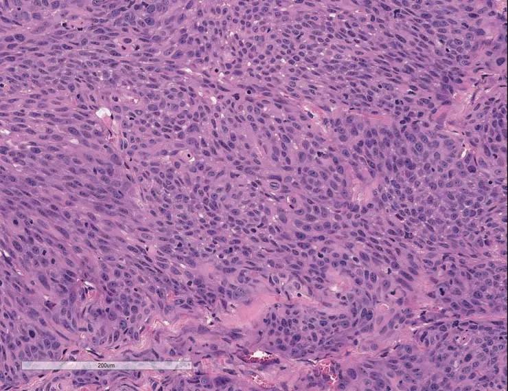 Figure B) Once engrafted, the histology for PDX model TM00015 at passage 1 also corresponds to high-rate urothelial carcinoma.