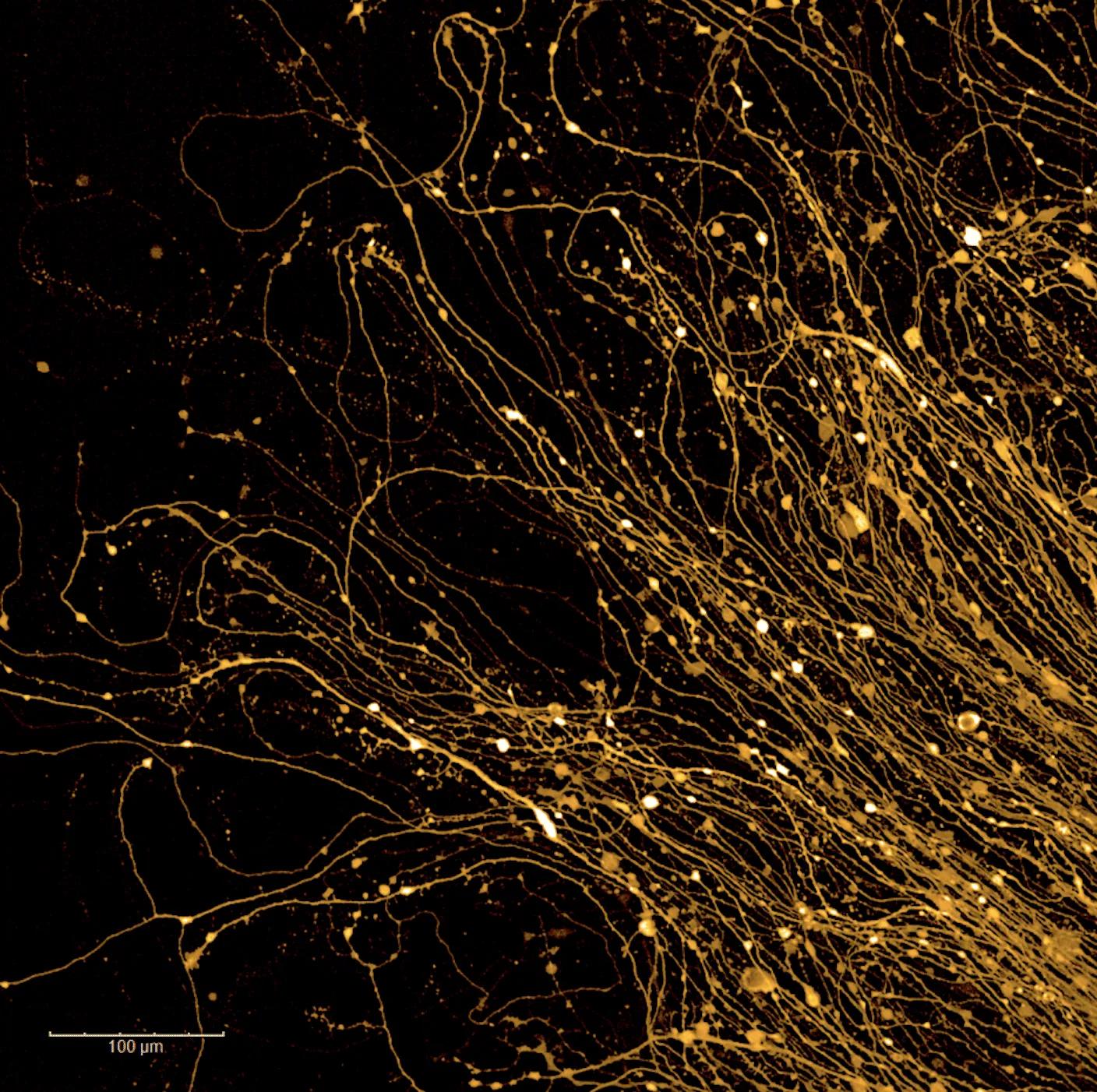 Neurons derived from the stem cells of Parkinson’s patients. Credit: Angelique Di Domenico, NYSCF