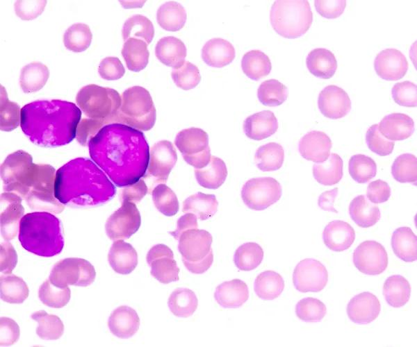 Patient-Derived Acute Myeloid Leukemia (AML) Models