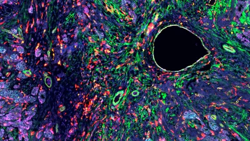 This is a rare type of tumor called Sertoli-Leydig tumor, which makes up fewer than 0.5% of all ovarian tumors. Imaged in the JAX Single Cell Biology Lab.