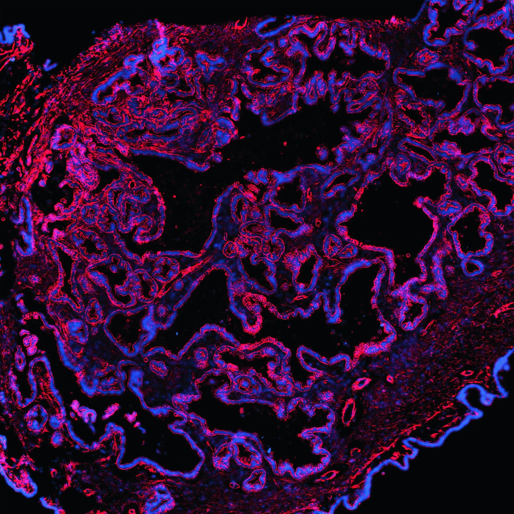 A ovarian carcinoma. Credit: Laura Andres-Martin, Ph.D.