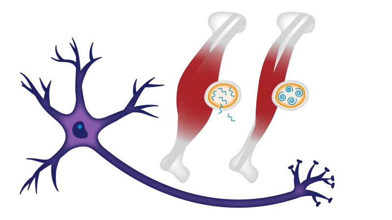 Myotonic Dystrophy (DM) 