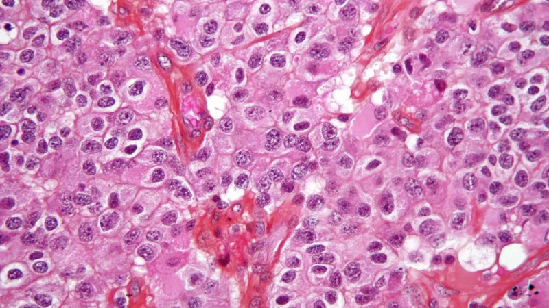 *What happens when brain tumors return? International study tracks genetic changes behind recurring cancers