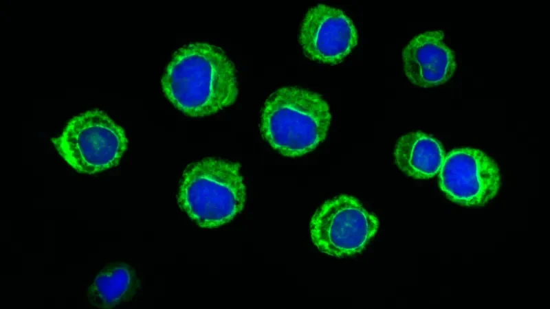 Fluorescent image of leukemic blast cells.