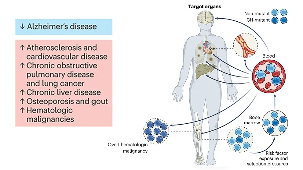 New study ties clonal hematopoiesis to protection against Alzheimer’s disease