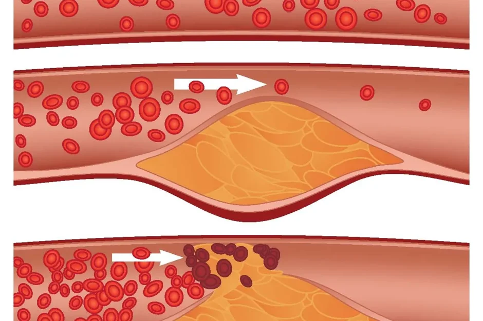 Which JAX mouse model is best for atherosclerosis studies: Apoe or Ldlr knockout mice?