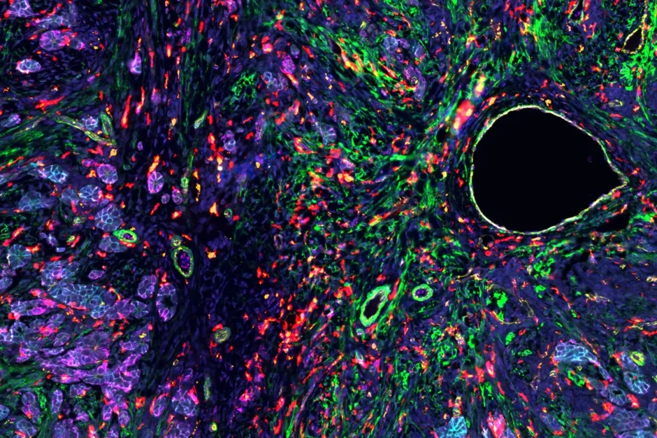 A cellular view of an ovarian tumor