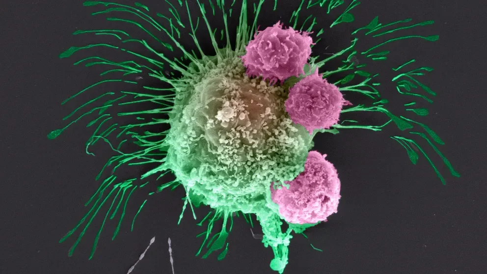 Cancer and its immune environment bioprinted and reproduced live and in 3D