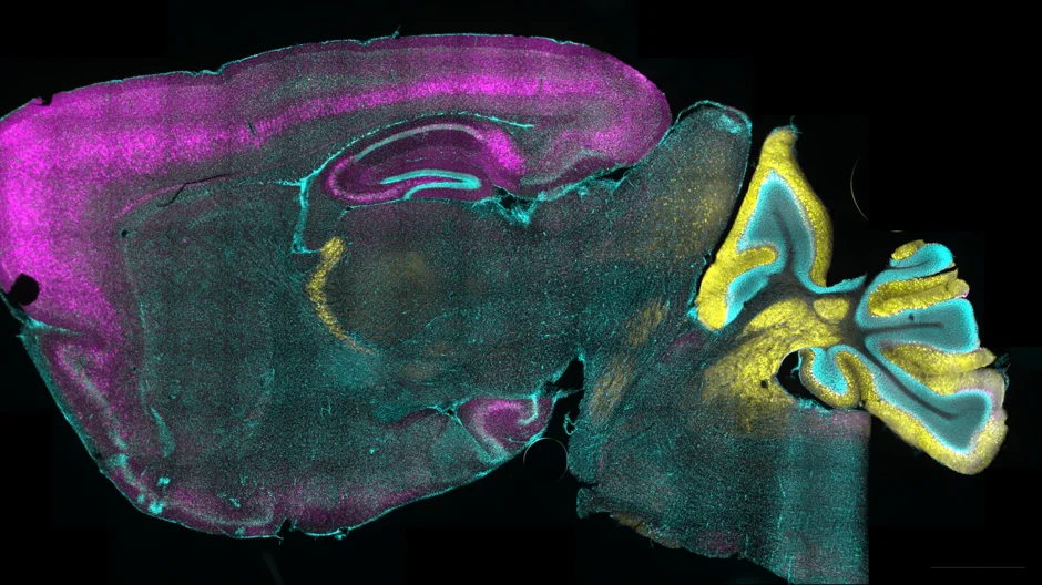 A cross-section image shows how the gene editing delivery system transduces the mouse brain. Pink marks where the virus reached cells, teal shows all brain cells, and yellow overlay highlights transduced inhibitory neurons involved in Dravet syndrome. 