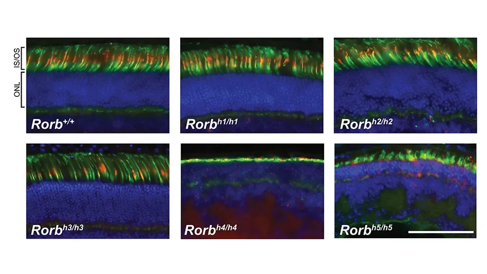 Gene loss associated with neurodevelopmental disorders