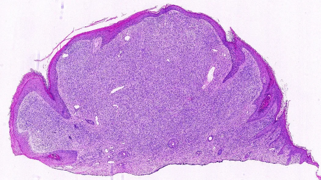 A hematoxylin and eosin (H&E) slide of a sarcoma, specifically a rhabdomyosarcoma.