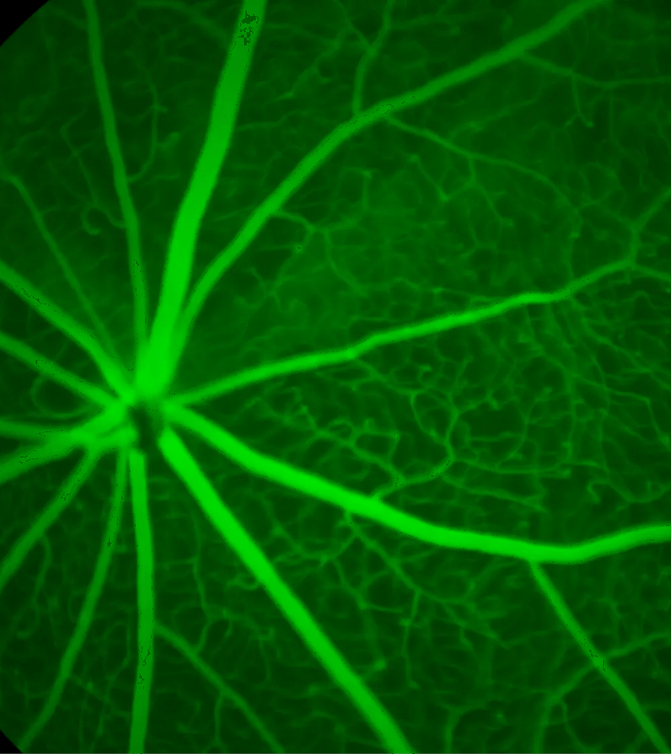 Electrodiagnosis of retinal di 三宅養三 Evaluating therapeutic potential of NR2E3 doses in the rd7 mouse