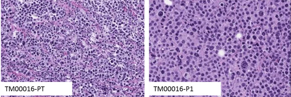 Histopathology reveals overall morphology and structure of JAX PDX tumors, engrafted in NSG™ mice and maintained at low-passage, which resemble the primary tumor from patients